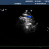 Dormed Hellas S7-2_7 TEE Cardiology