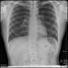 Dormed Hellas X-RAY 80kv 5mA 0.3sec