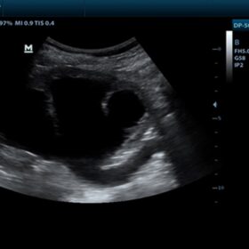 Dormed Hellas DP-50 - Hydronephrosis