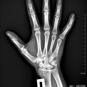Dormed Hellas X-RAY HAND_R AP_25