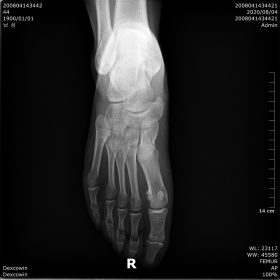 Dormed Hellas X-RAY Image 11 Sole 75kV 5mA 0.3 sec