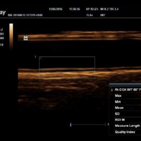 Dormed Hellas M6 - Carotid-IMT