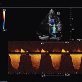 Dormed Hellas M7 - Mitral regurgitation color Doppler