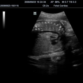 Dormed Hellas M7 - OB Fetal Aortic Arch
