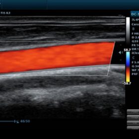Dormed Hellas DC-30 - Color Flow of Carotid
