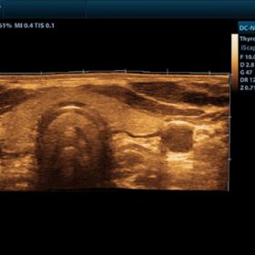Dormed Hellas DC-N2 - Thyroid iScape