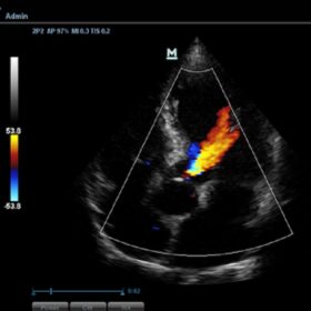 Dormed Hellas DC-N3 - Aortic Regurgitation