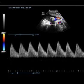 Dormed Hellas DC-N3 - Umbilical artery color flow and pw