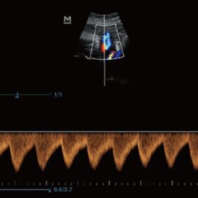 Dormed Hellas Z50 - PW of Umbilical Artery