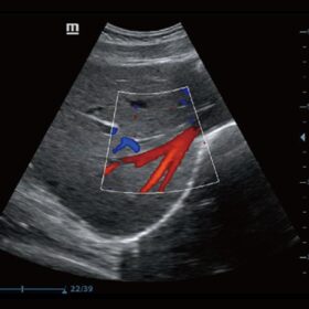 Dormed Hellas Z60 - Color Flow of Liver