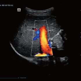 Dormed Hellas Z60 - Color Flow of Portal Vein