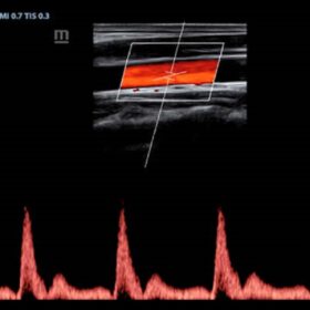 Dormed Hellas Z60 - PW of Carotid