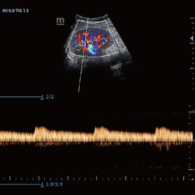 Dormed Hellas Z60 - PW of Renal Artery