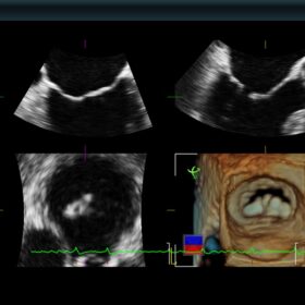 Dormed Hellas 880 Ultrasound - 3DTEE, Mitral Valve display