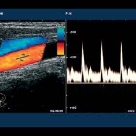 Dormed Hellas 6500HV - Carotid Color Doppler