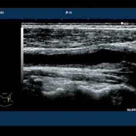 Dormed Hellas 6500HV - Carotid HI Compound