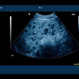 Dormed Hellas 6500HV - Contrast metastasizing carcinoma