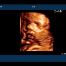 Dormed Hellas 6500HV - OB 4D fetal