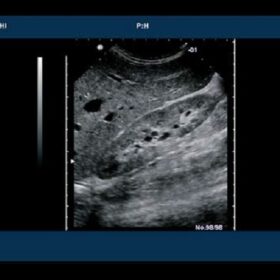 Dormed Hellas 6500HV - Right Kidney