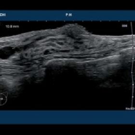 Dormed Hellas 7500HV - Breast