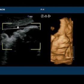Dormed Hellas 7500HV - OB 4D Fetal