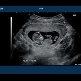 Dormed Hellas 7500HV - OB Fetal