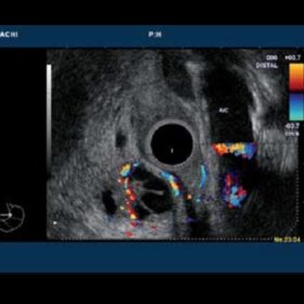 Dormed Hellas 7500HV - Radial Color Pancreatic