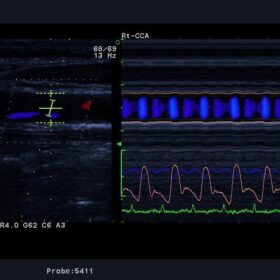 Dormed Hellas A10 - Carotid echo-tracking