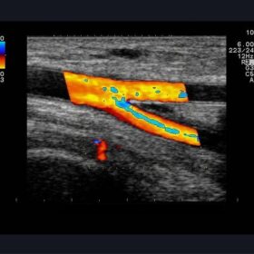 Dormed Hellas A10 - Veins