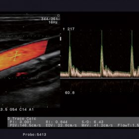 Dormed Hellas A6 - Carotid Color Doppler