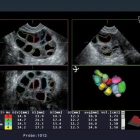 Dormed Hellas A7 - Multi-follicle Volume Measurement (MFV)