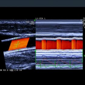 Dormed Hellas A7 - Wave-Intensity