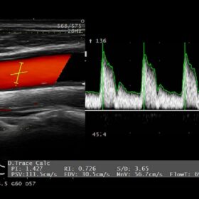 Dormed Hellas AR50 - Doppler Auto Trace