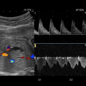 Dormed Hellas AR60 - Obst - Dual Doppler
