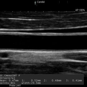 Dormed Hellas AR60 - Vascular - Auto IMT