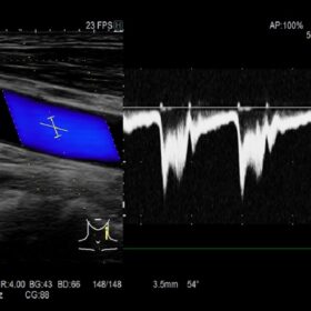 Dormed Hellas AR65 - Vascula Carotid Dop
