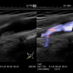 Dormed Hellas AR65 - Vascular Carotid Dual CF
