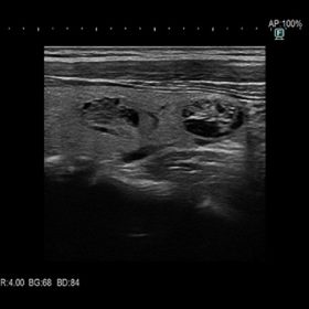 Dormed Hellas ARIETTA AR650 - Adenomatous goiter