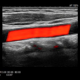 Dormed Hellas ARIETTA AR650 - CF Carotid Artery