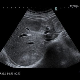 Dormed Hellas ARIETTA AR650 - Hemangioma