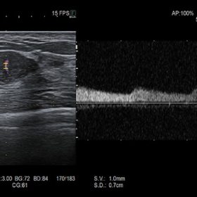 Dormed Hellas ARIETTA AR650 - PW Doppler Fibroadenoma