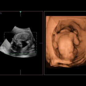Dormed Hellas AR70 - 4D Fetal