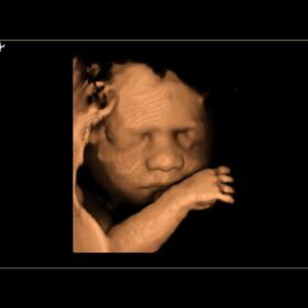 Dormed Hellas AR70 - 4D Fetal face