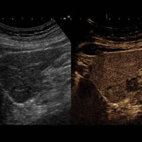 Dormed Hellas AR70 - Abdomen Contrast