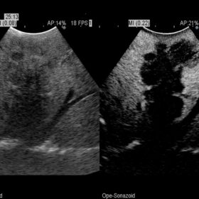 Dormed Hellas AR70 - Intraoperative contrast of a large liver metastasis