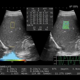 Dormed Hellas AR750 - Liver Shear Wave and Attenuation measurement