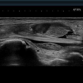 Dormed Hellas AR750 - Wrist synovial proliferations due to trauma