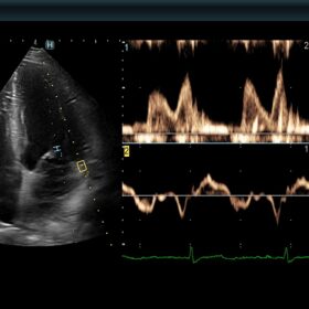 Dormed Hellas AR850 - LV diastolic performance indicator and E-e' ratio