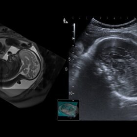 Dormed Hellas AR850 - RVS in fetal brain