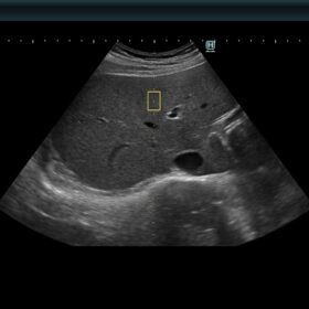 Dormed Hellas AR850 - Shear wave measurement